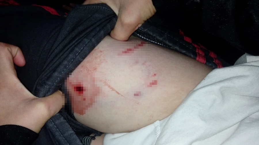 Tekirdağ’da pitbull dehşeti: 10 yaşındaki çocuğu bacağından ısırdı 